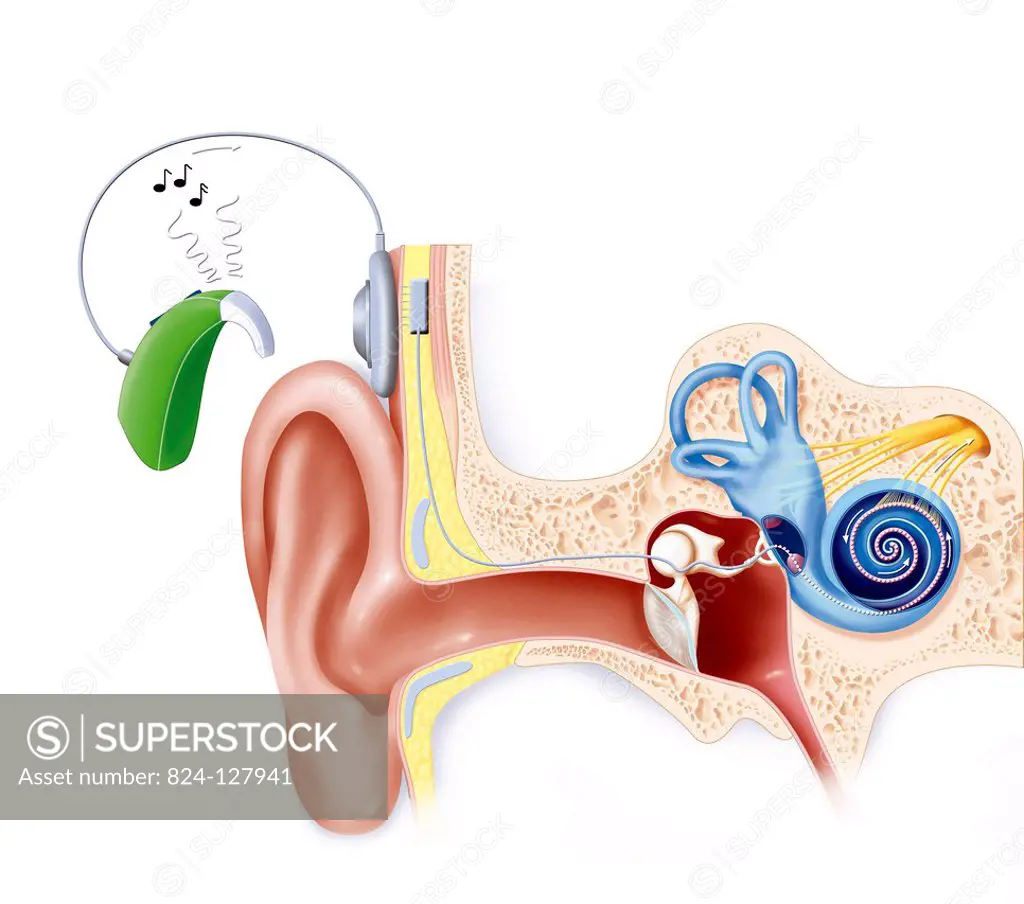 Illustration of a cochlear implant in the ear, showing how sound travels to the brain. The transmitter is worn behind the ear, linked to a transmittin...