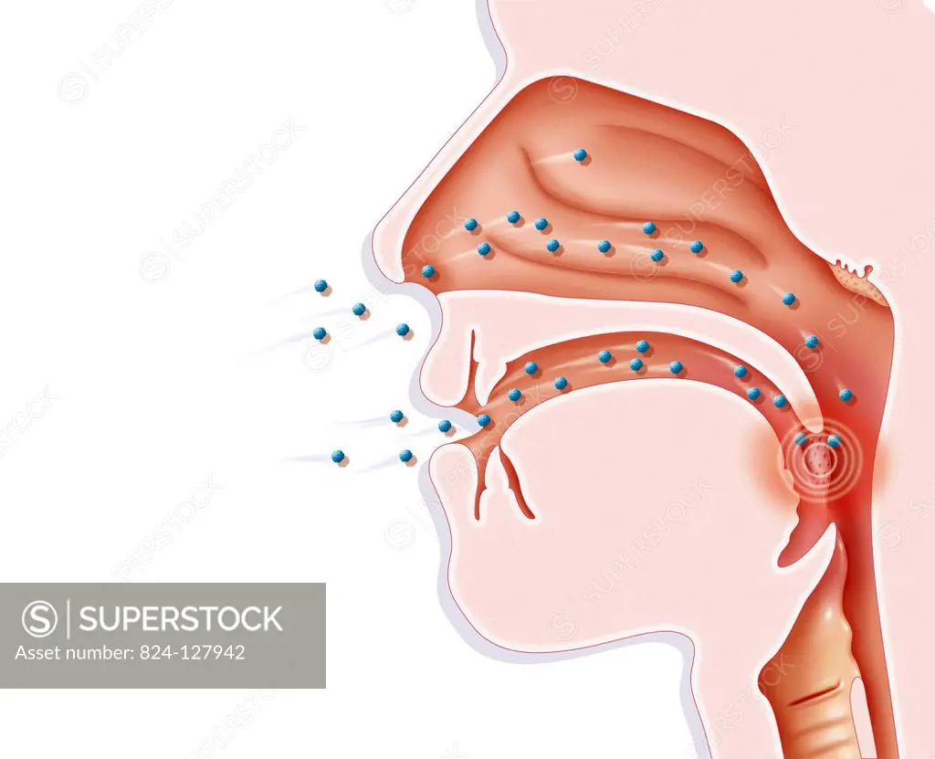 Illustration of where the tonsils are located, in the path of inhaled air and ingested food. Tonsils are the first protective barriers, which trap bac...