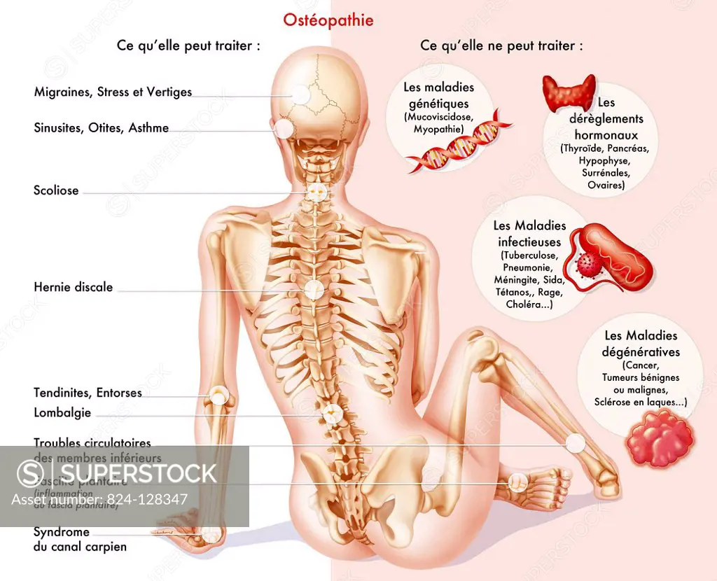 Illustration of illnesses that can and cannot be treated by osteopathy. Osteopathy can treat : migraines, stress, dizziness, sinusitis, eat infections...