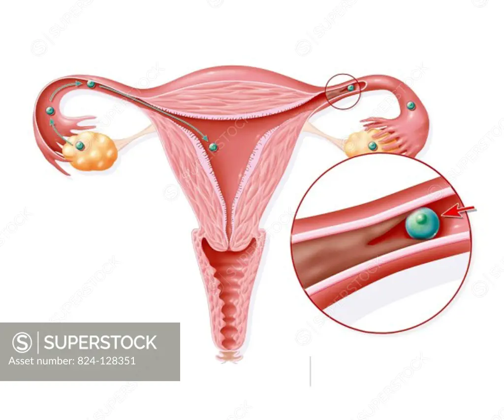 Illustration of an infection as a result of the Chlamydia bacterium. Chlamydia trachomatis is responsible for a large part of infertilities, by obstru...