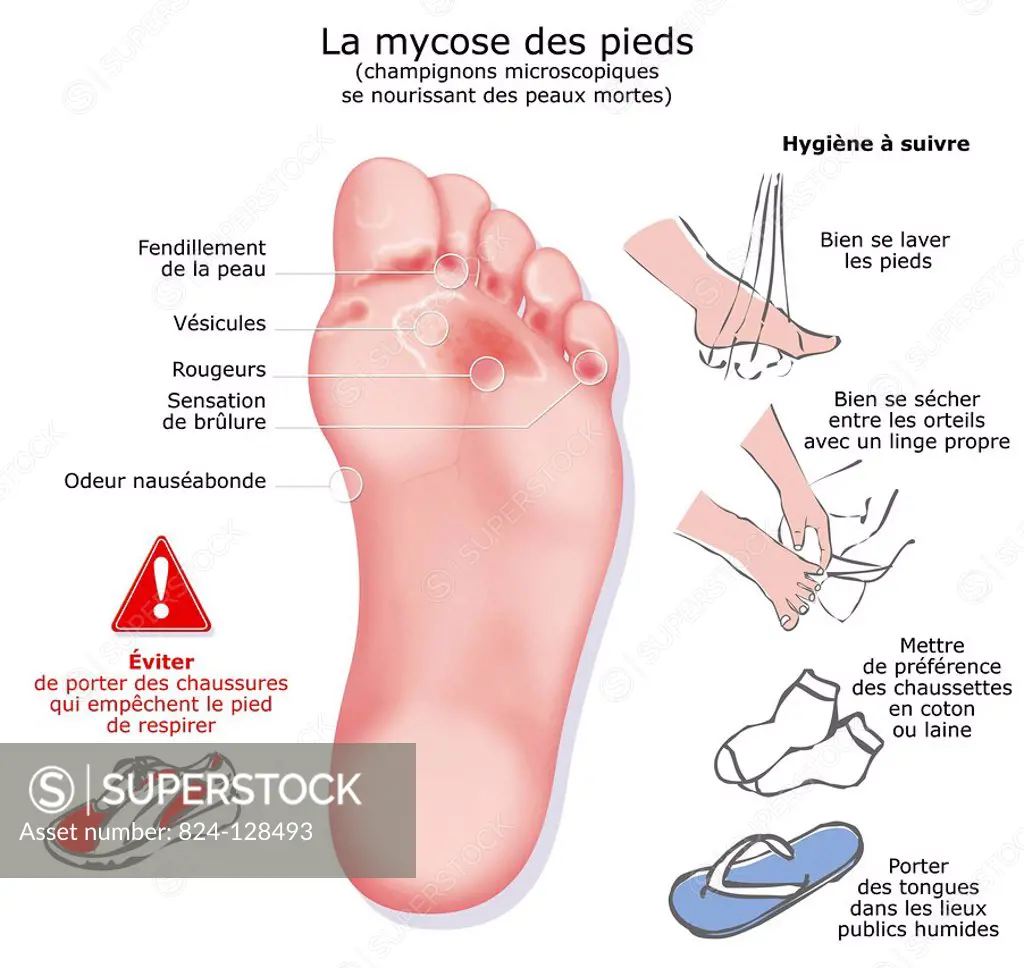 Illustration of athletes foot. Athletes foot causes the skin to crack, a burning sensation, blisters on the sole of the foot, as well as red patches...