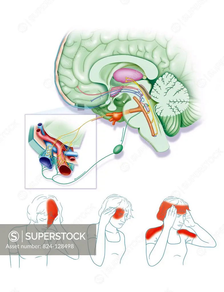 Illustration of a migraine. The migraine is caused by the dura mater vessels swelling (at the dura mater). The trigeminal nerve transmits the informat...