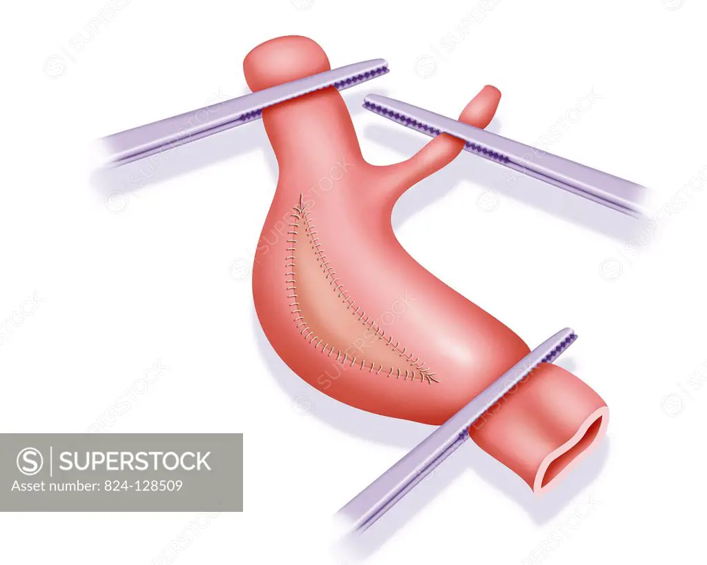 Illustration of vascular surgery with an endarterectomy. The operation involves, after the vessel has been clamped and incised, removing the atheromat...