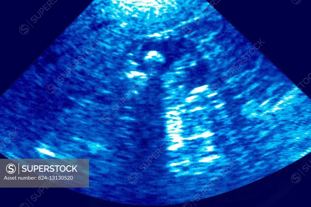 Gallstone seen on an ultrasound scan of the abdomen.