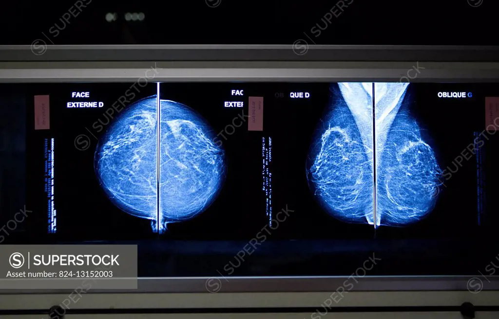 Reportage in a radiology service in a hospital in Haute-Savoie, France. Mammogram.