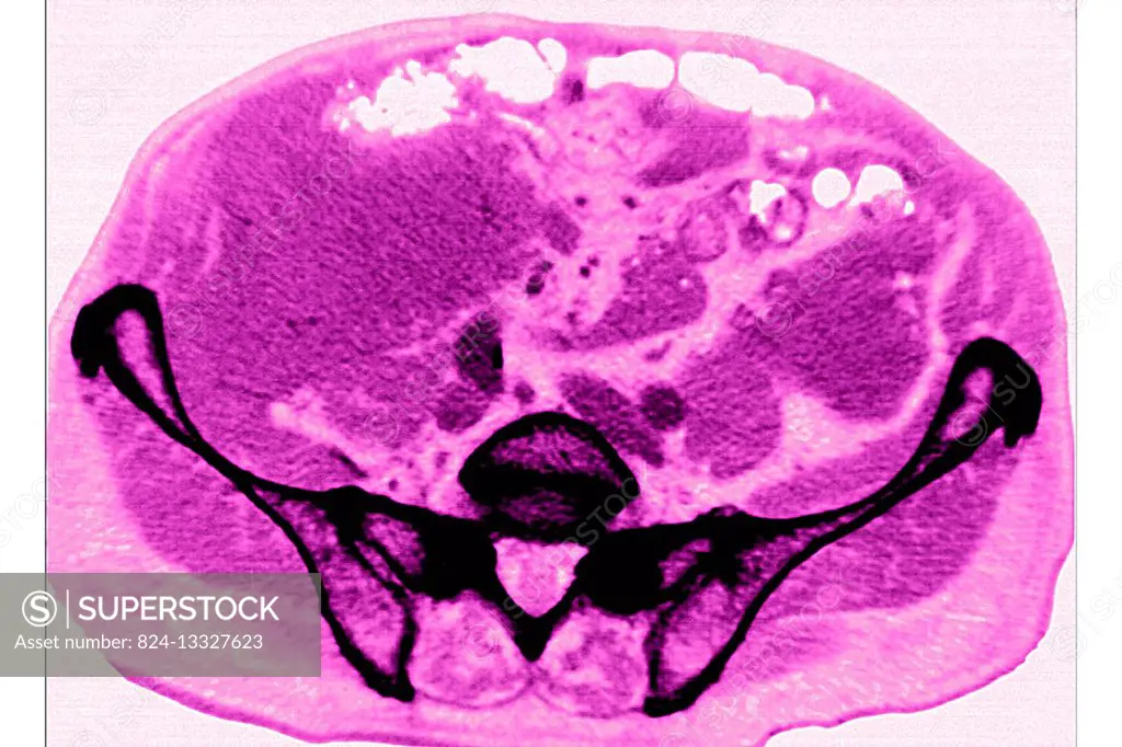 Amyloidosis of the intestine, seen on a radial section CT scan.