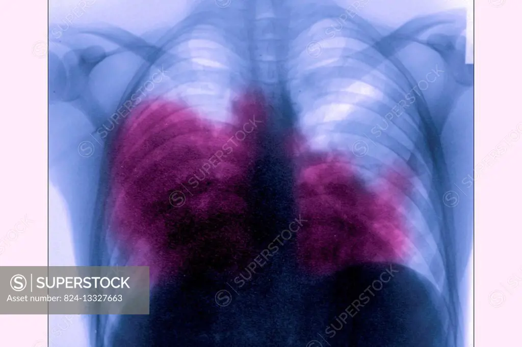 Acute bilateral pneumonia (legionnaires disease caused by Legionella pneumophila), seen on a frontal chest x-ray.