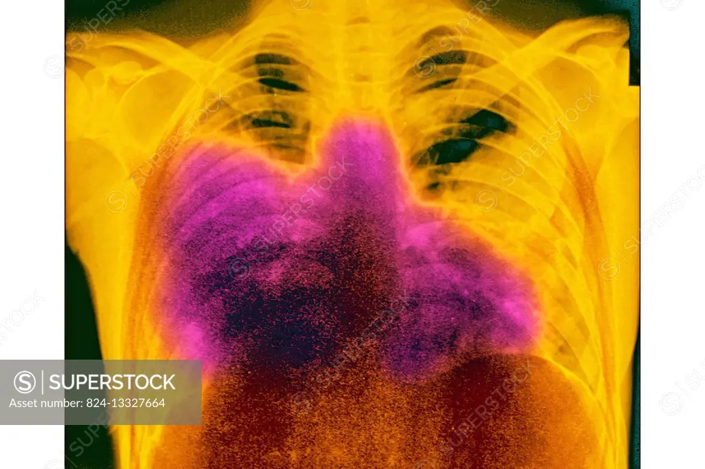 Acute bilateral pneumonia (legionnaires disease caused by Legionella pneumophila), seen on a frontal chest x-ray.