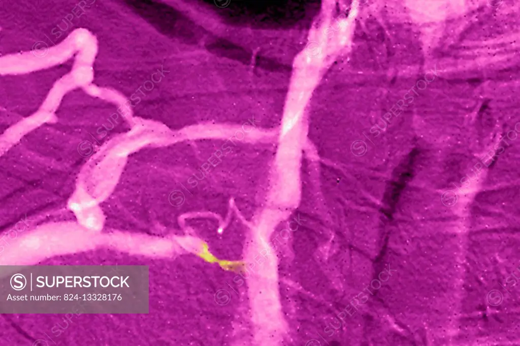 Venous stenosis of the superior vena cava seen in a frontal chest angiogram.