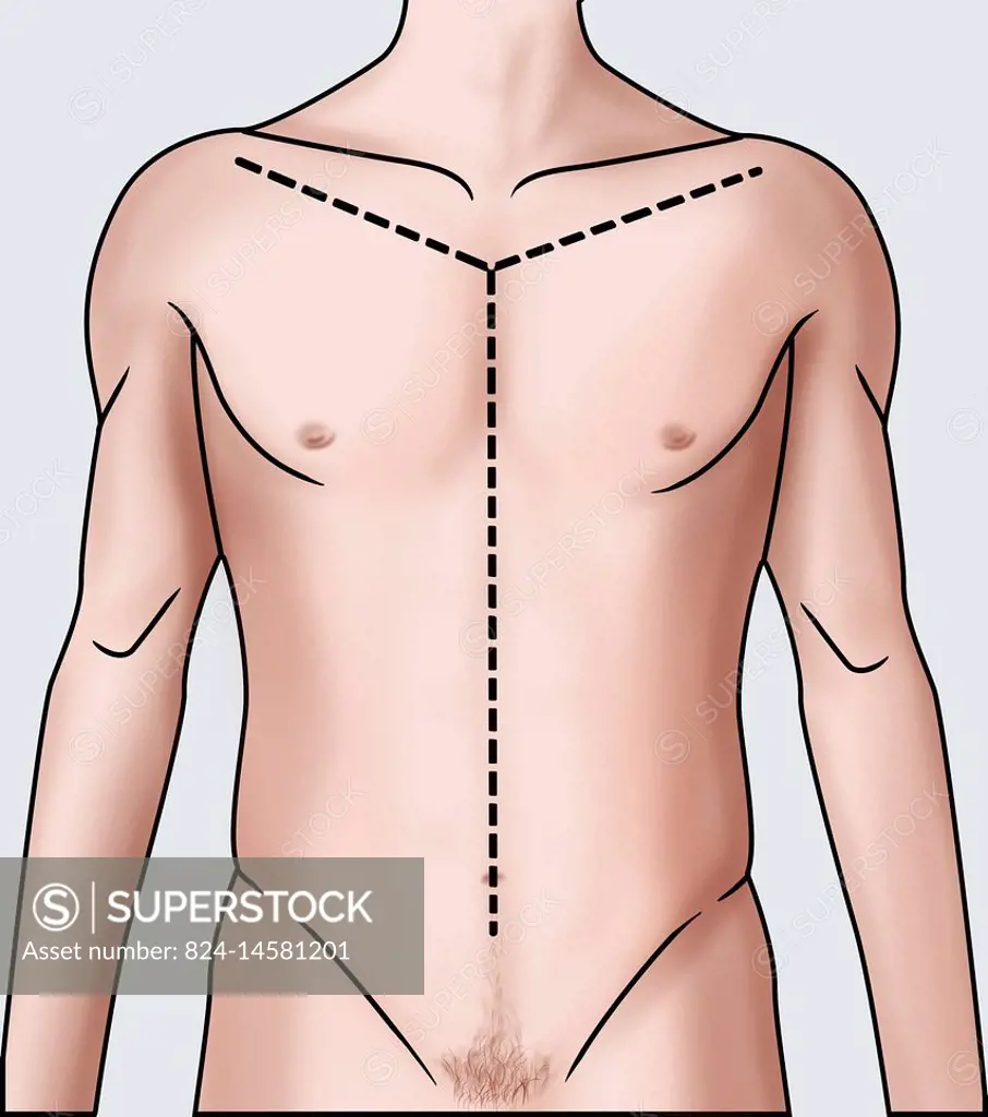 Illustration showing the Y-shaped incision made during an autopsy. -  SuperStock