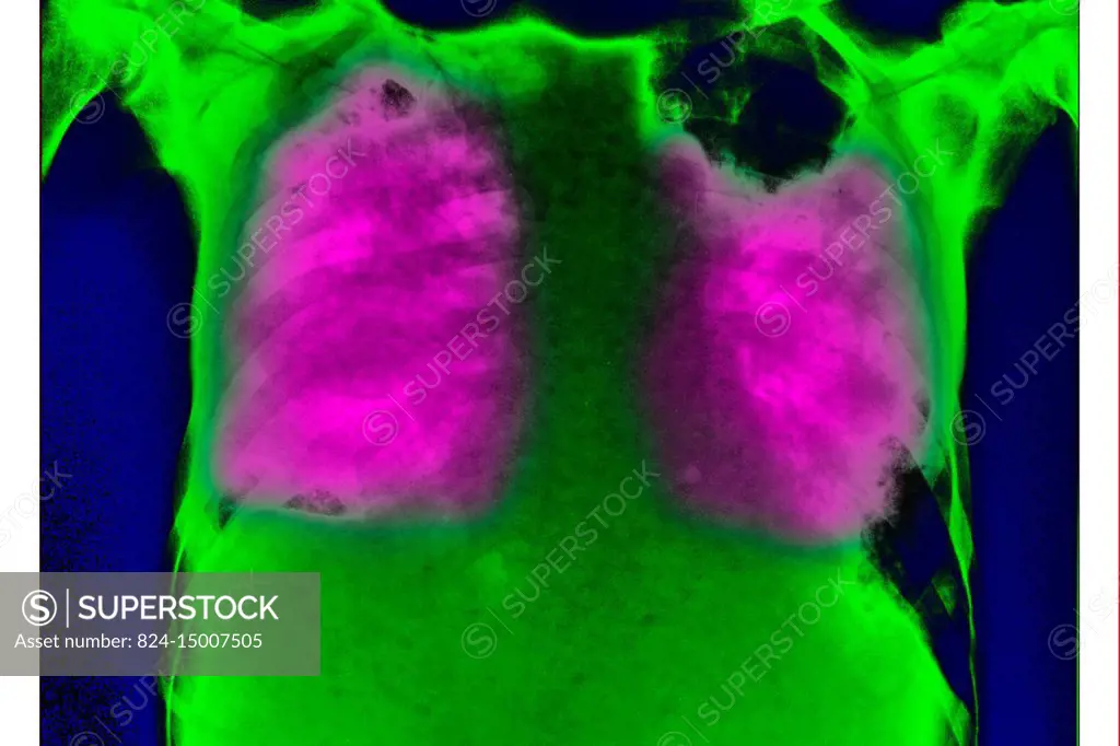 Allergic bronchopulmonary aspergillosis (ABPA), seen on a frontal chest x-ray.