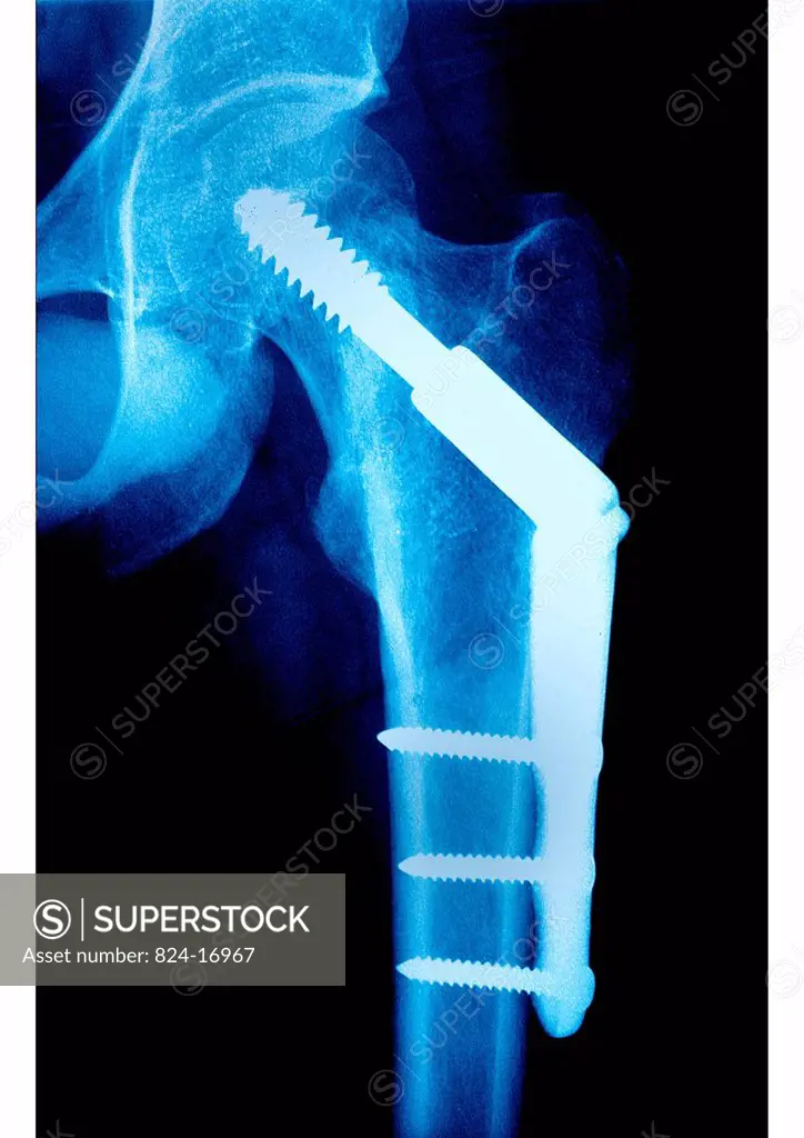 Osteosynthesis by screws and plaques and screws on a femur neck. Frontal x_ray of the left hip.