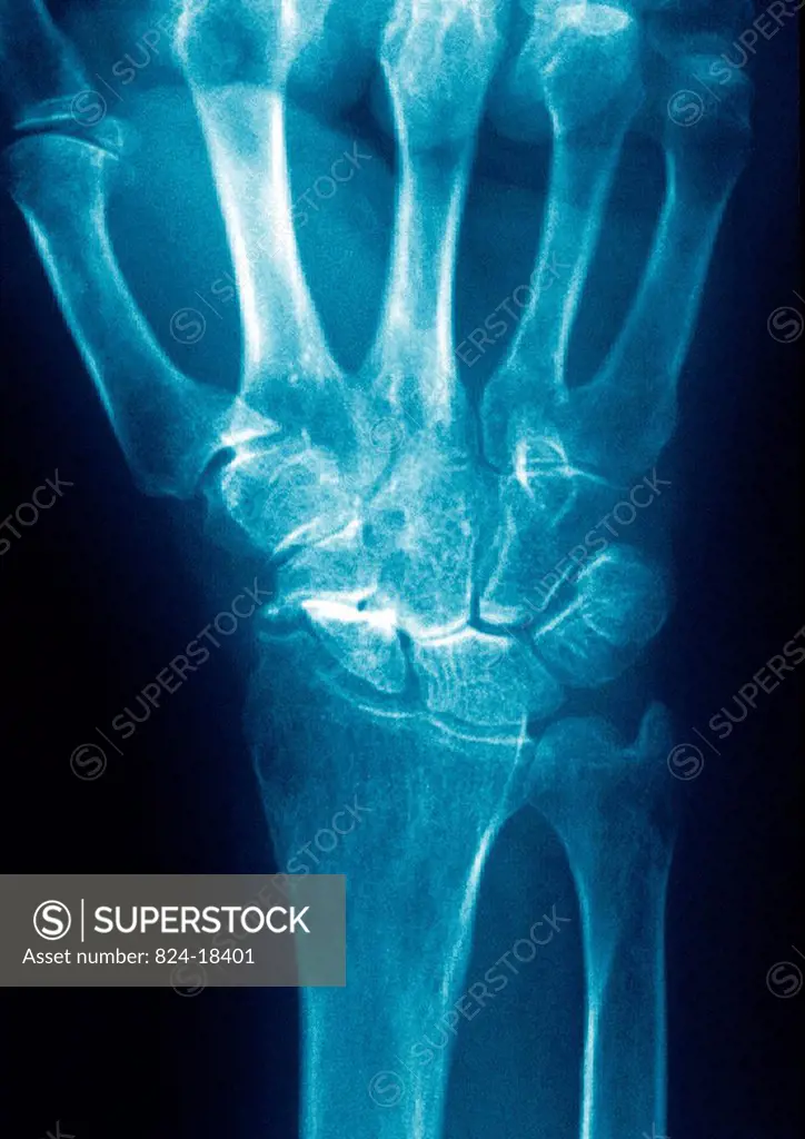 Post_traumatic wrist arthritis. X_ray of left hand.