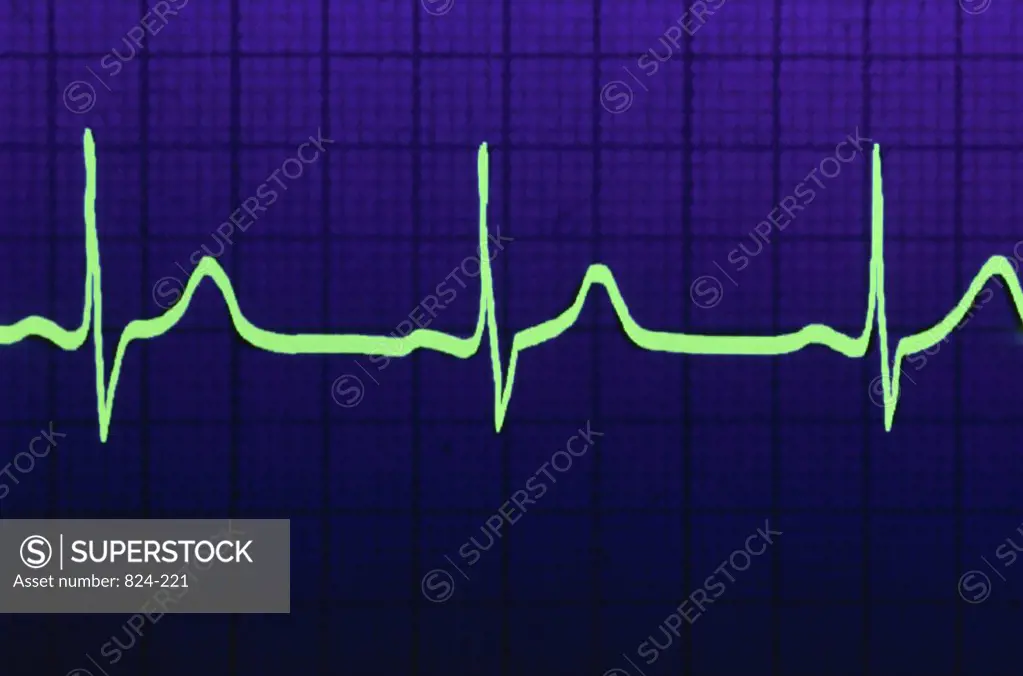 Normal Electrocardiograph Tracing