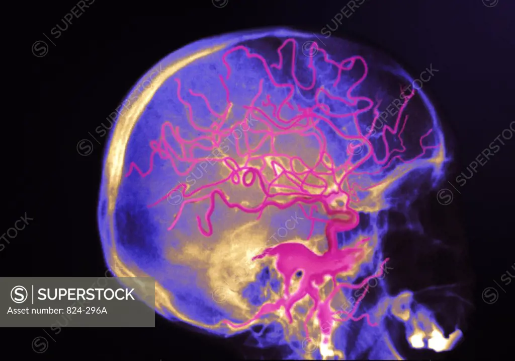 Brain Arteriography Showing Aneurysm