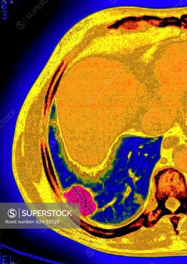 LUNG METASTASIS, SCAN. Pulmonary metastases secondary cancer, carcinoma. Thoracic scan in axial section.