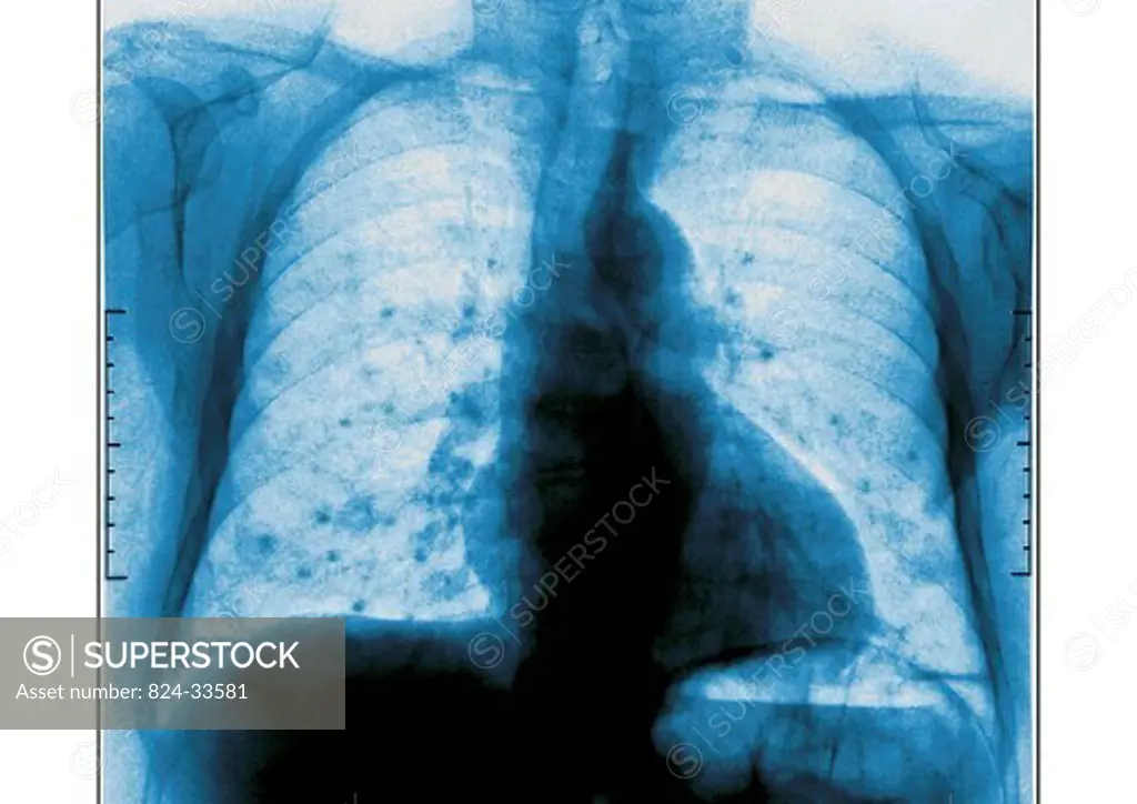 LUNG METASTASIS, X_RAY. Pulmonary metastases secondary cancer, carcinoma. Thoracic x_ray in front view.