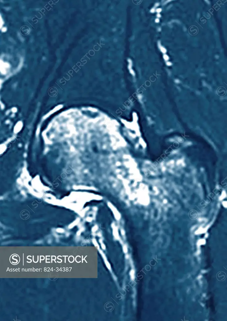 This frontal MRI image of the left hip reveals an osteonecrosis bone death of the femoral head.
