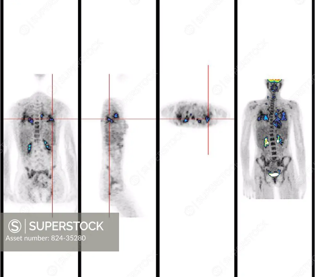 HODGKIN´S DISEASE<BR>Institute of Nuclear Medicine, University Hospital of Lille, France.   PET Scan (Positron emission tomography).  Hodgkins disease...