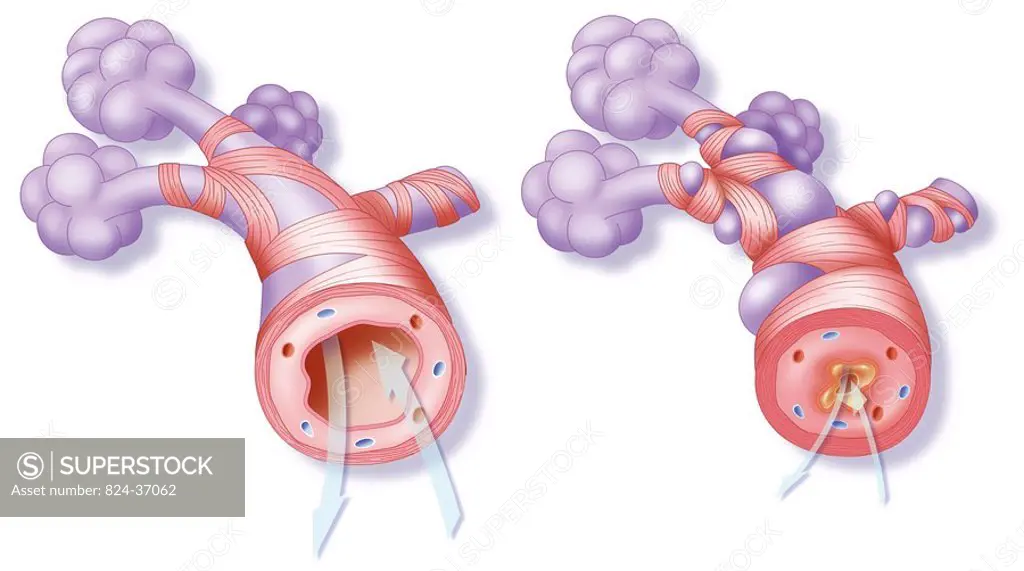 ASTHMA, DRAWING<BR> <BR>Healthy and asthmatic bronchioli.  Representation, on the left, a healthy bronchiolus in which the breathing is normal.  Repre...