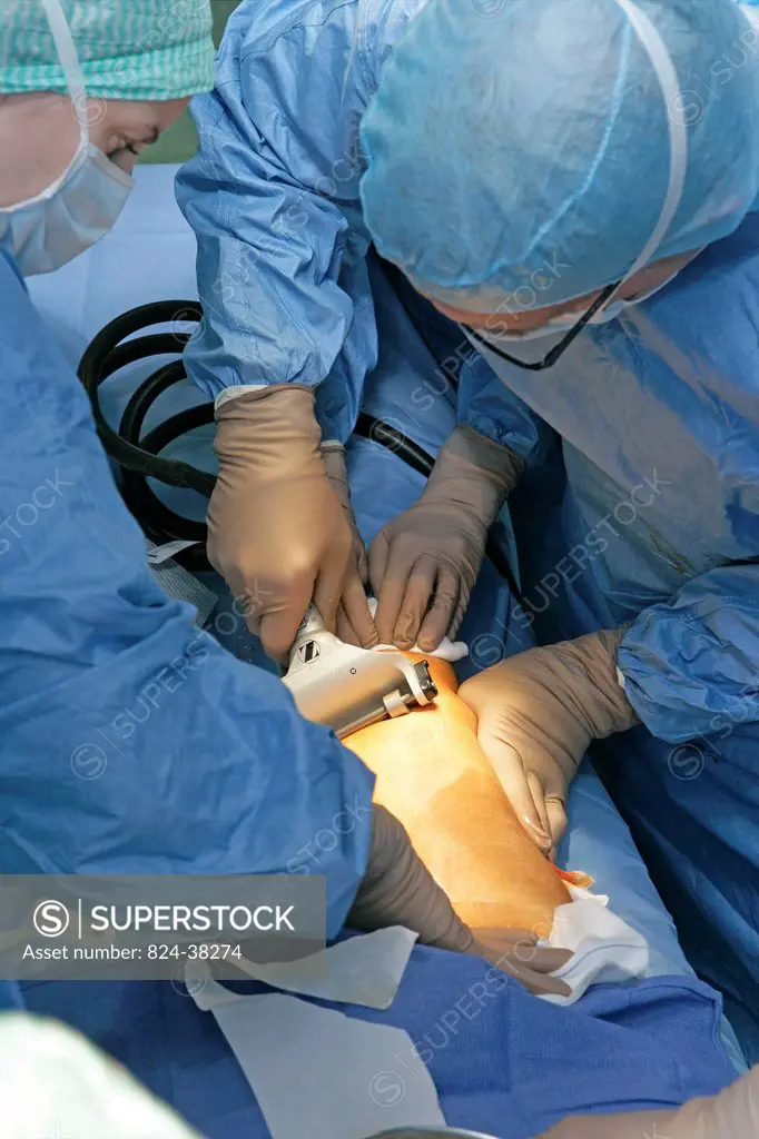 Photo essay at Rouen hospital, France. Plastic surgery. Skin grafting on the thorax of a man, the transplant is taken from the thigh of the patient.