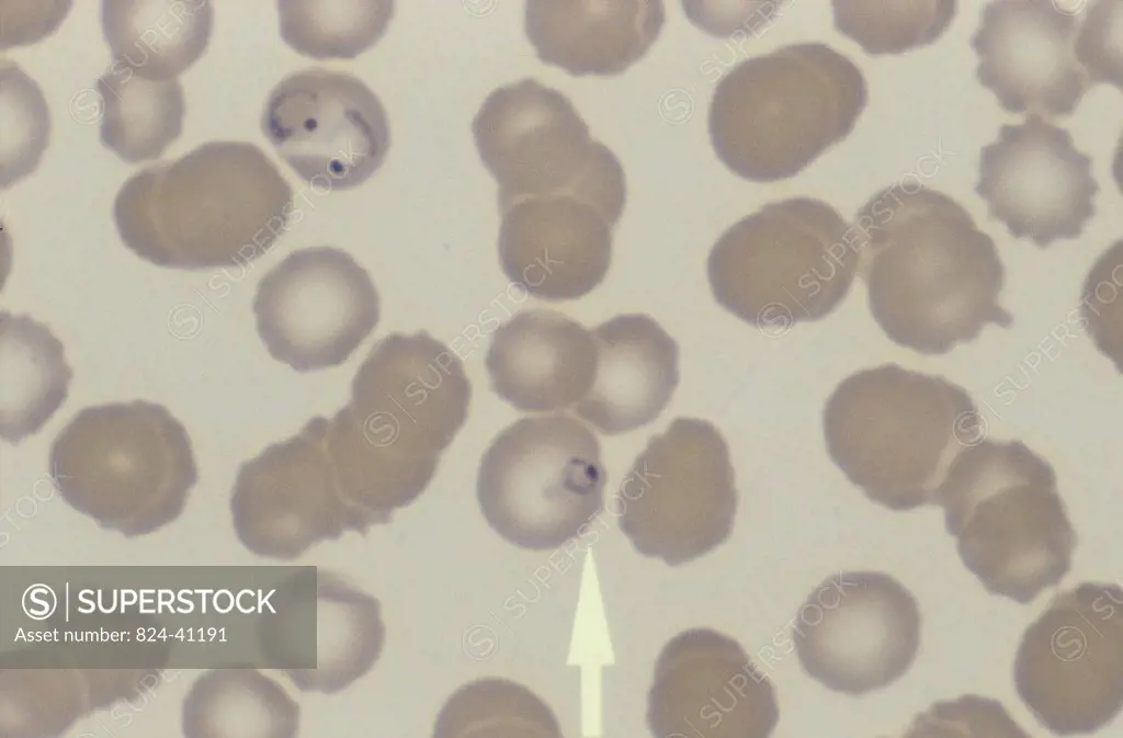 PLASMODIUM FALCIPARUM MALARIA<BR>Plasmodium falciparum. Magnification : 1000x.