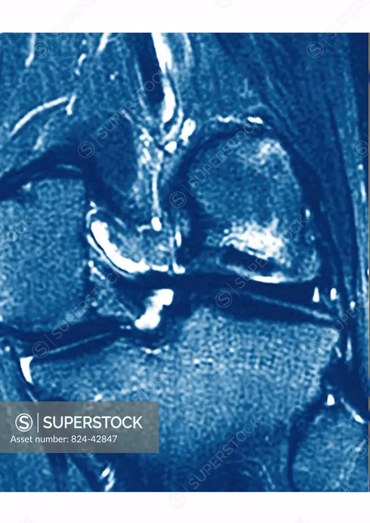 This frontal MRI image of the knee shows a exostosis of the thighbone.