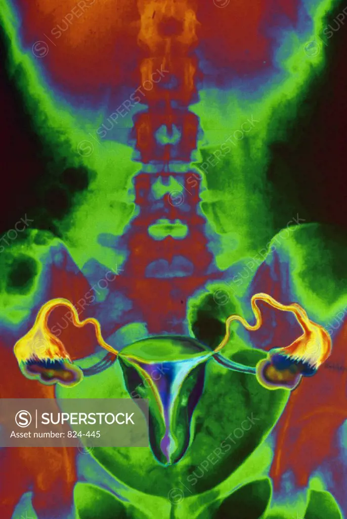 X-ray image of female reproductive system