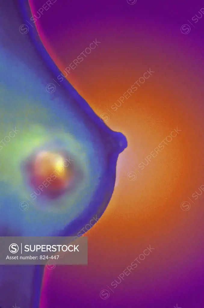 X-Ray Showing Breast Cancer