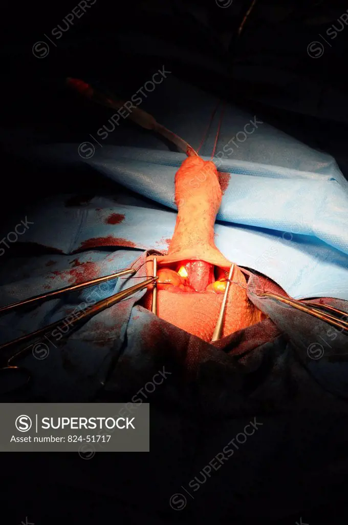 Photo essay at Lyon hospital. Department of urology. Surgical treatment of erectile dysfunction with a penile prosthesis.
