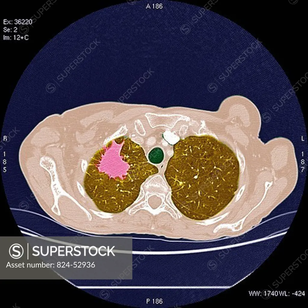 LUNG CANCER, SCAN. Lungs in brown with cancer in pink.