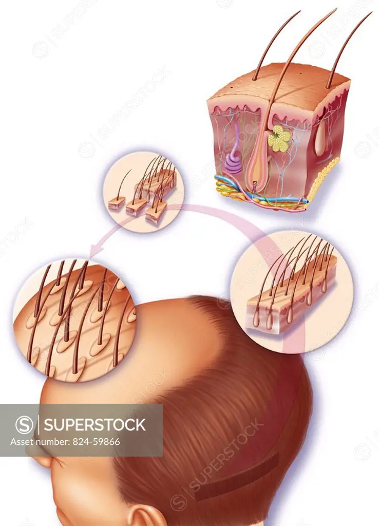 IMPLANT HAIR SURGERY<BR>Hair implants.<BR>Illustration of skin anatomy with hair follicles showing a hair implantation operation on a man suffering fr...
