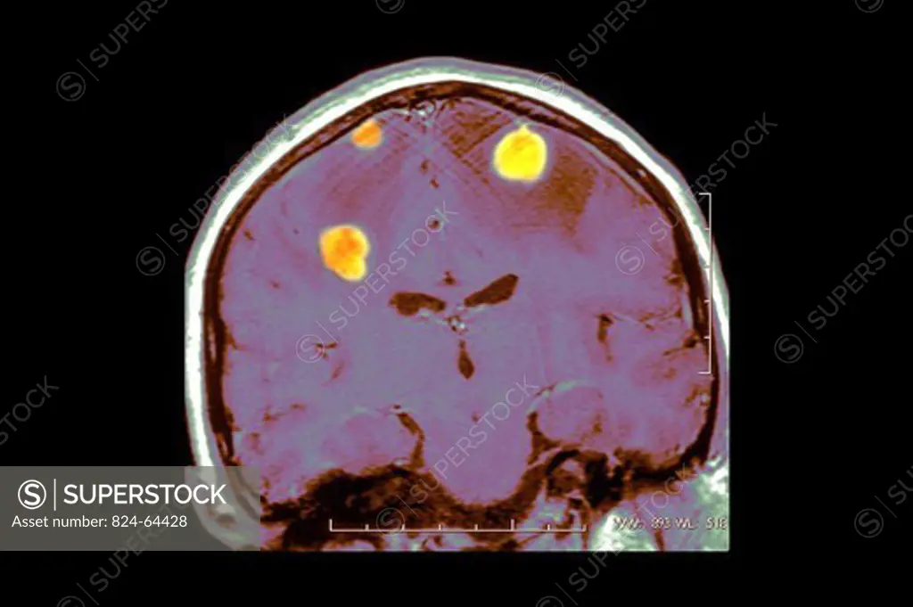 METASTASIS IN THE BRAIN, MRI. METASTASIS IN THE BRAIN, MRI Gadolinium enhanced MRI-T1. Coronal cut-away. Idiopathic metastases causing generalized epileptic seizures in a 40-year-old man.