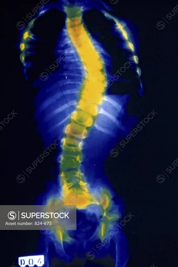 X-Ray Showing Rickets Disease