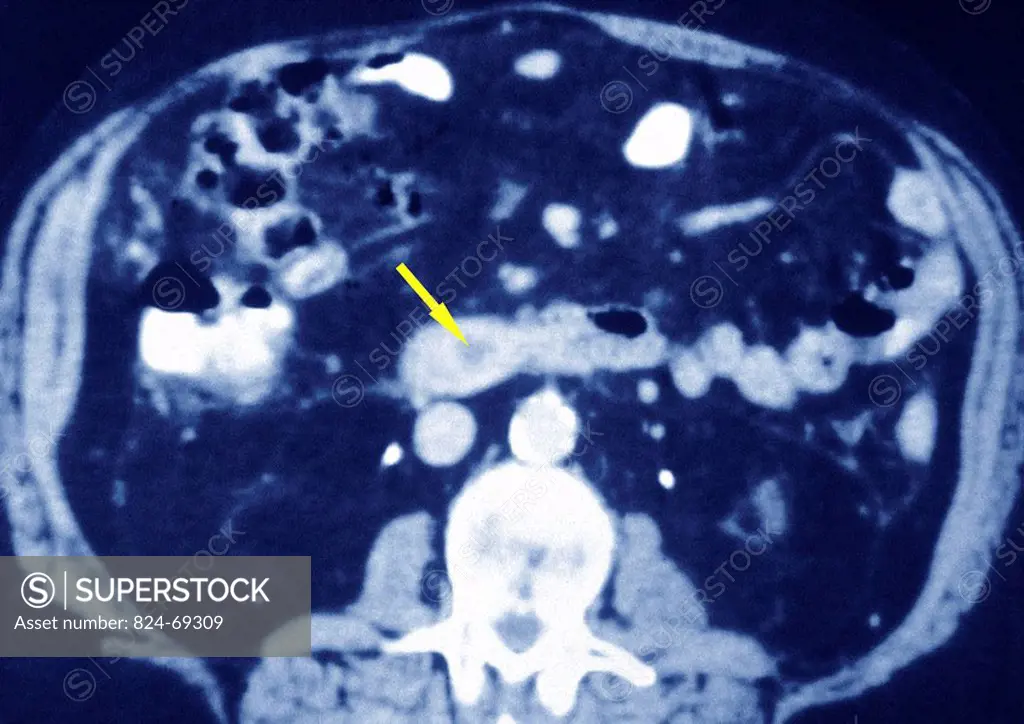 PANCREATIC CALCULUS, SCAN Lithiasis in the pancreas abdominal scanner, transversal section. See. Image 8564706 for a zoom in on the calculus.