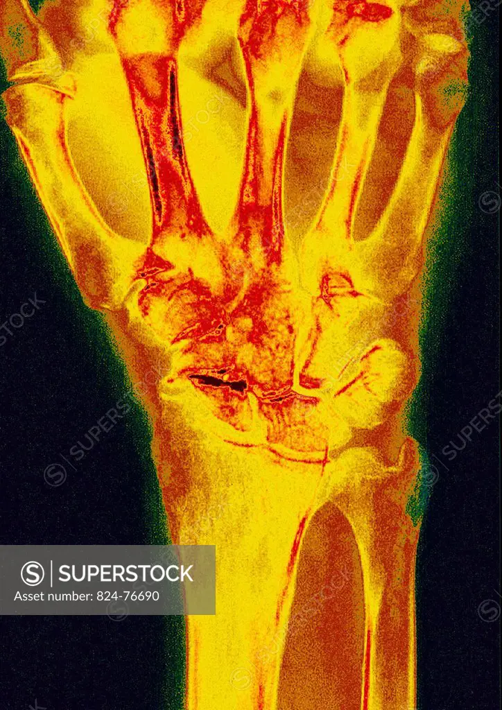 Post_traumatic wrist arthritis. X_ray of left hand.