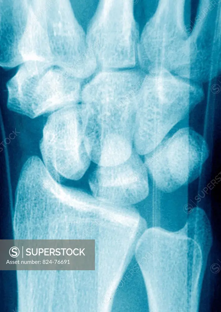 Fracture of the carpal scaphoid. X_ray of a left wrist.
