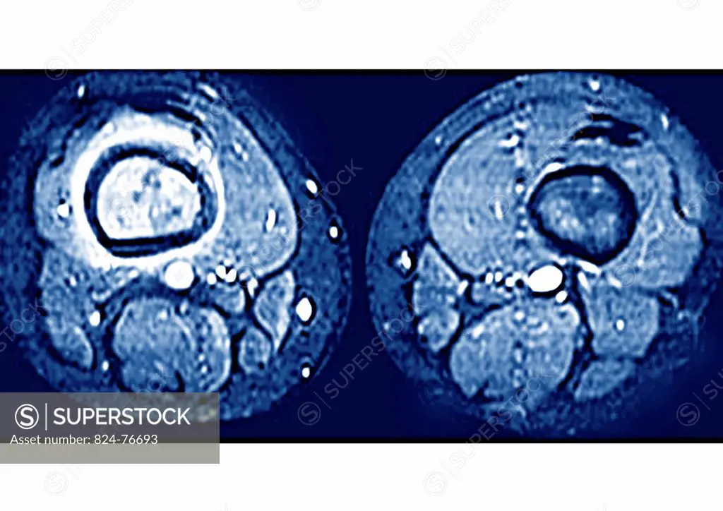 This axial MRI image reveals an ostéosarcoma of the right thighbone.
