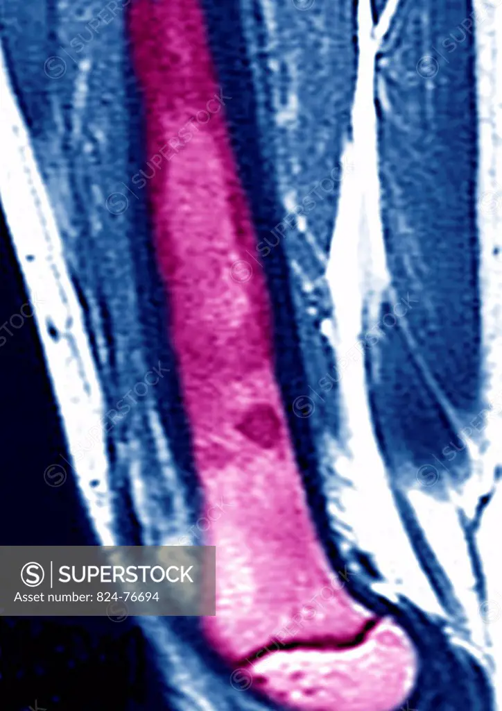 This sagittal MRI image of the thighbone reveals an ostéosarcoma.