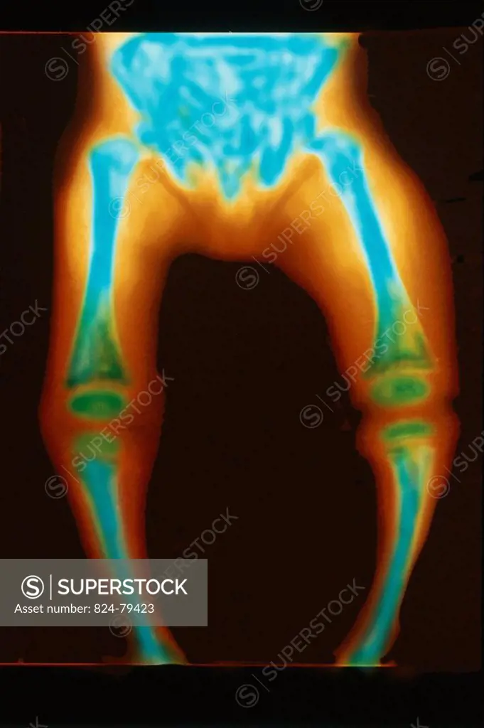 RICKETS, X-RAY<BR>Rickets is a childhood disorder involving softening and weakening of the bones, primarily caused by lack of vitamin D which in turn ...
