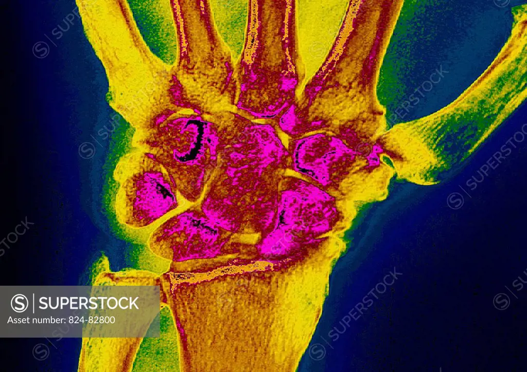 Post_traumatic wrist arthritis. X_ray of right hand.