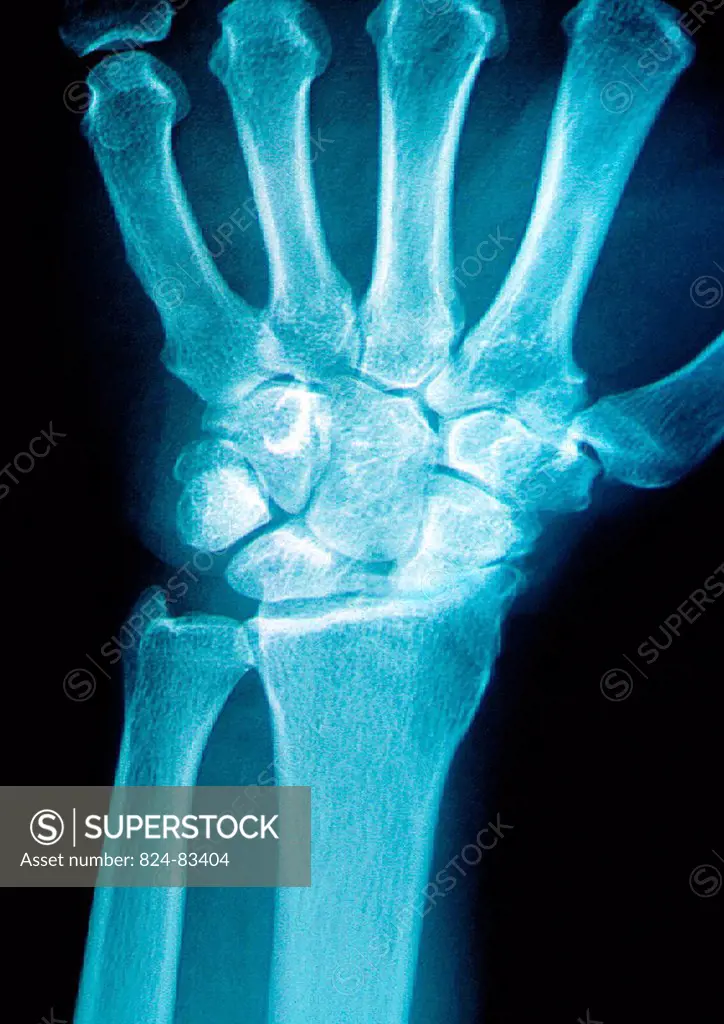 Post_traumatic wrist arthritis. X_ray of right hand.