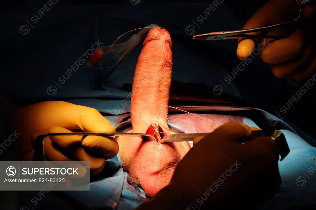 Photo essay at Lyon hospital. Department of urology. Surgical treatment of erectile dysfunction with a penile prosthesis. Test of erection with prosth...