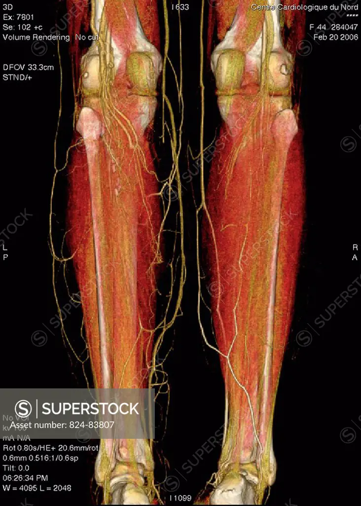 Angiography scanner 3D. Angiography scanner 3D at the level of the calves posterior view. Visualization of the skeleton system tibia and fibula and va...