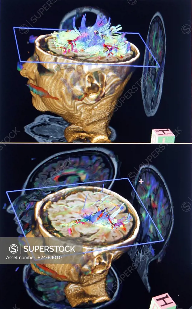 3D reconstruction of MRI images of a child brain.