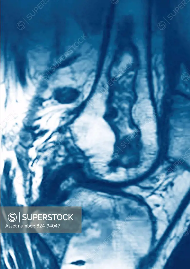 This sagital MRI image of the knee shows a femoral infarction.