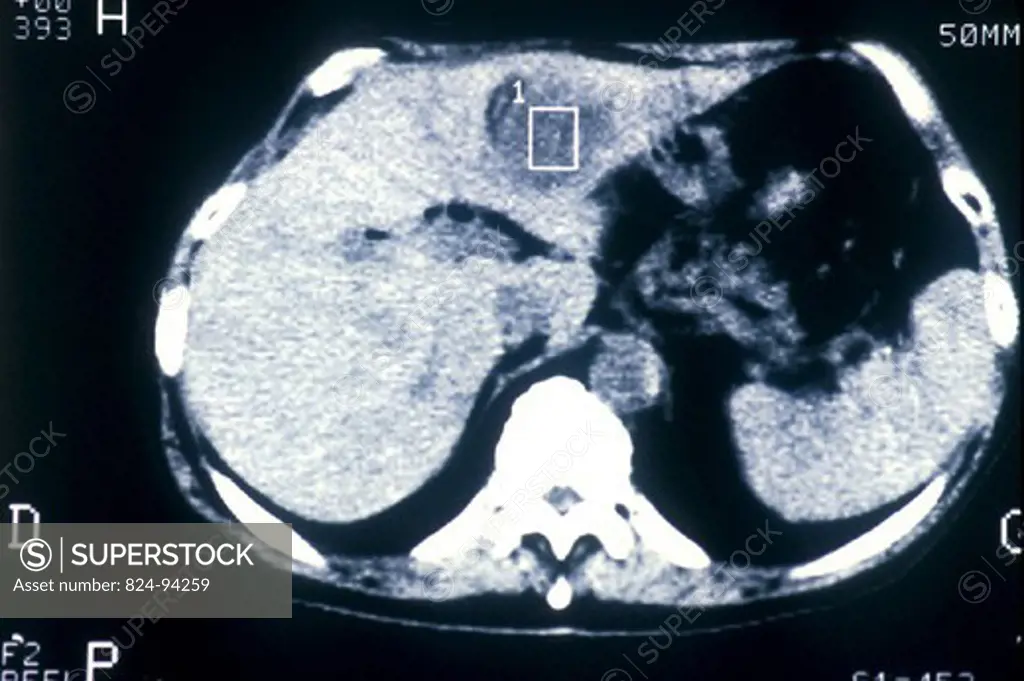 CANCER OF THE LIVER, SCAN. CANCER OF THE LIVER, SCAN Malignant tumor.