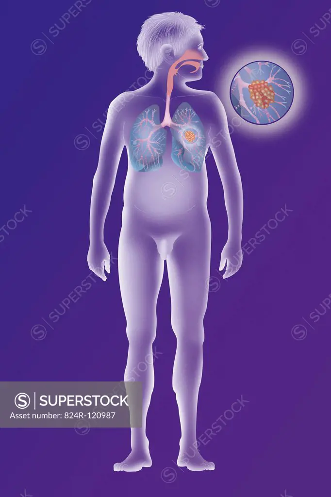 Depiction of a cancerous tumour in the left lung.