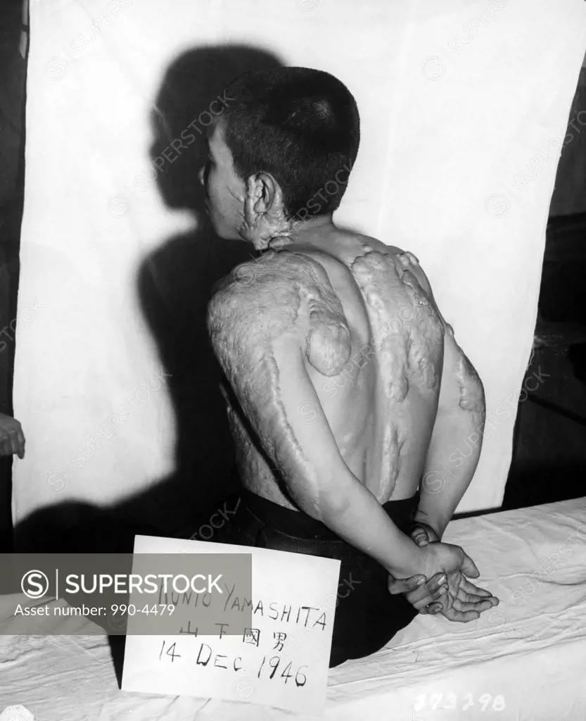 Japan, Nagasaki, Nagasaki atomic bomb burn victim sitting on the bed, December 1946